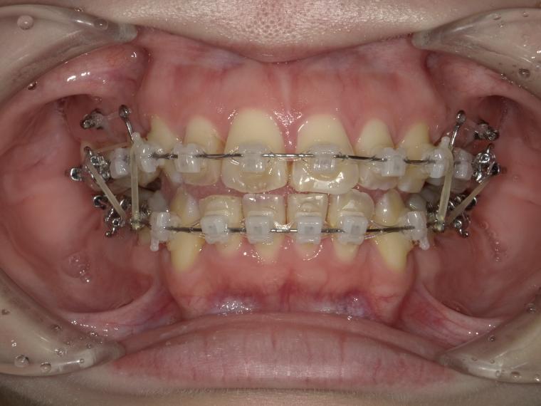 ワイヤーの色について